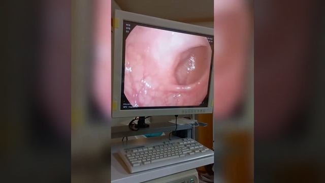 КОЛОНОСКОПИЯ С УГЛЕКИСЛЫМ ГАЗОМ ЛЕГЧЕ ПЕРЕНОСИТСЯ! смотреть онлайн