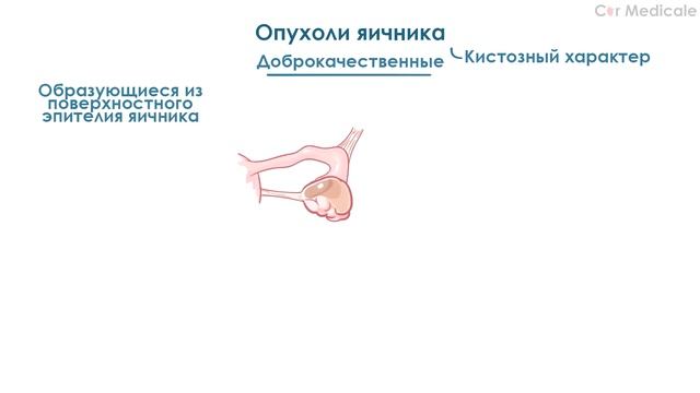 Кисты яичников: что такое, виды, симптомы, осложнения, принцип лечения