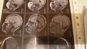 МОЖНО ЛИ ЛЕЧИТЬ АГЕНЕЗИЮ МОЗОЛИСТОГО ТЕЛА И КИСТУ ПОЛУШАРИЯ МОЖЕЧКА?