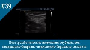 УЗИ вен. Посттромботические изменения глубоких вен нижних конечностей
