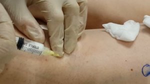 Склеротерапия Sclerotherapy