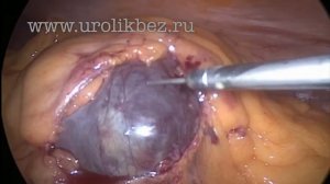 Лапароскопическая декортикация кисты левой почки|laparoscopic kidney cyst resec (архив 2017 г.)