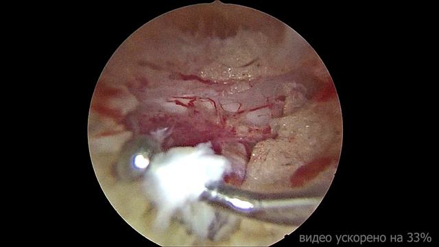 Грыжа L5-S1UBE смотреть онлайн