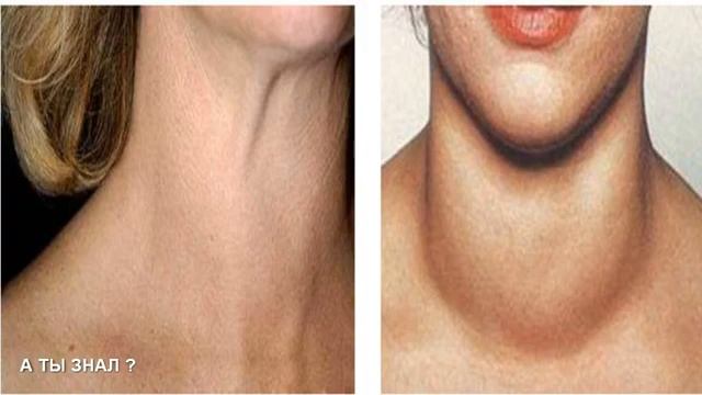 ЩИТОВИДКА будет РАБОТАТЬ КАК ЧАСЫ если ПОЧЕМУ НЕ УСВАИВАЕТСЯ ЙОД и нарушается работа ЩИТОВИДКИ смотреть онлайн