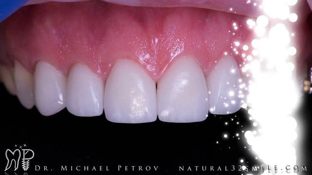 Преображение улыбки, виниры, люминиры, отбеливание, Invisalign, стоматолог Петров Михаил