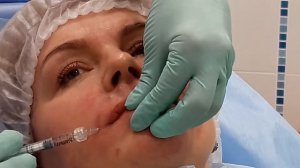 Меди-Лайт: Коррекция периоральной области (Принцесс Вольюм). Носогубная складка, марионетки, морщи