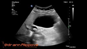 КАМНИ и  ХОЛЕСТЕРОЗ желчного пузыря на УЗИ. ВЕНТИЛЬНЫЙ КАМЕНЬ. Gallbladder stones and cholesterosis