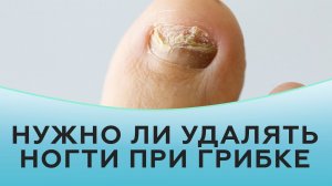 Нужно ли удалять ногти при грибке?