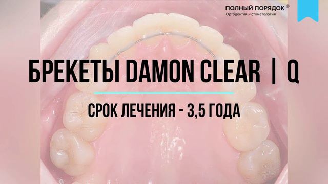 Лечение скученности с удалением — достаточно длительное, но эффективное!