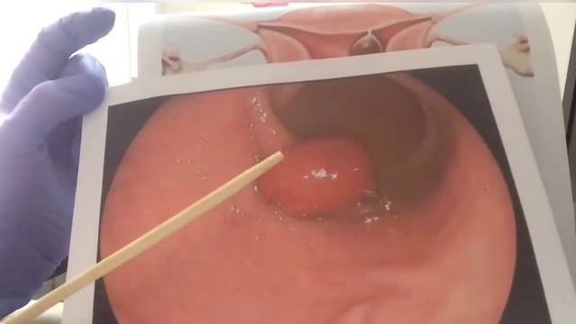 POLIP HAQIDA MA’LUMOTLAR VA UNI DAVOLASH смотреть онлайн