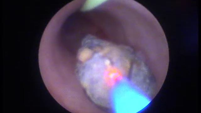 Holep   Flex URS смотреть онлайн