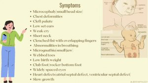 Edward's Syndrome(trisomy 18)-causes,symptoms and diagnosis