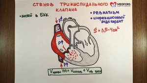 Стеноз трёхстворчатого клапана Просто о сложном