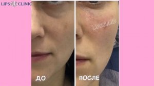 Заполнение носослезной борозды - до и после