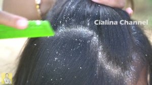 Long Hair Combing, Extreme Damage - Dandruff Shampoo and Huge Flake Scratching #790