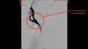 Стентирование левой и правой внутренней сонной артерии