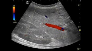 холангиокарцинома