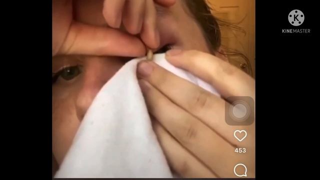 СРОЧНО!!! ОГРОМНОМНЫЙ ПРЫЩ НА ГЛАЗАХ смотреть онлайн