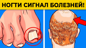 Как определить болезнь по ногтям? | Ногти скажут ВСЁ о вашем здоровье!