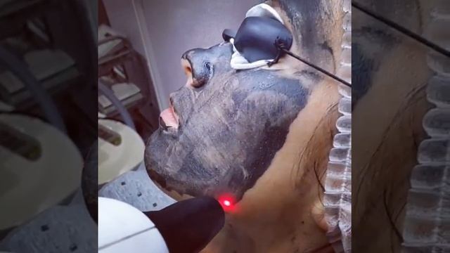 Карбоновый пилинг на аппарате MBT-800 смотреть онлайн