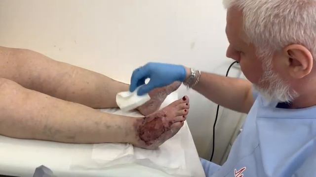 Как принять полноценный душ и помыться с трофической язвой и не намочить повязку