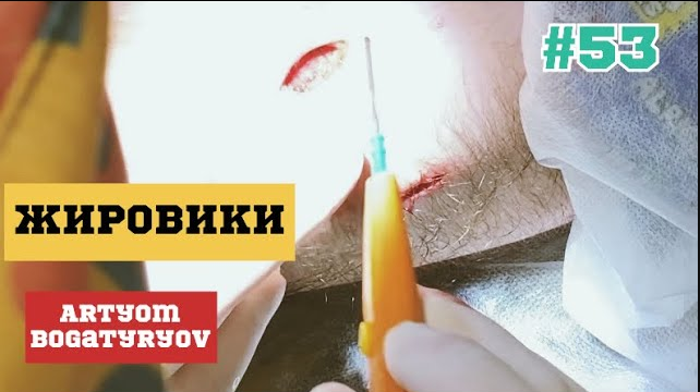 53. Удаление жировиков #53