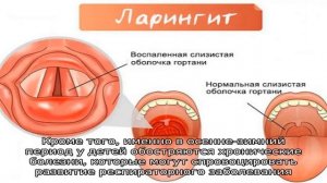 Основные причины возникновения ларингита у ребенка