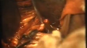 Медфильм СССР. Трансплантация почки