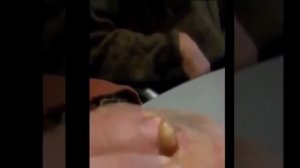 Извлечение личинки овода