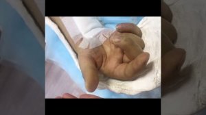 Повреждение нерва и сухожилий кисти