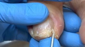 The amazing curl of the ingrown nails! Trim it carefully【Xue Yidao】