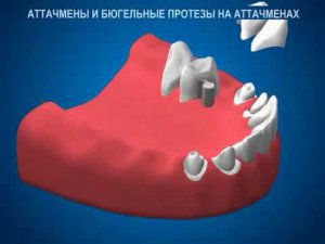 Бюгельный протез на замках-аттачментах