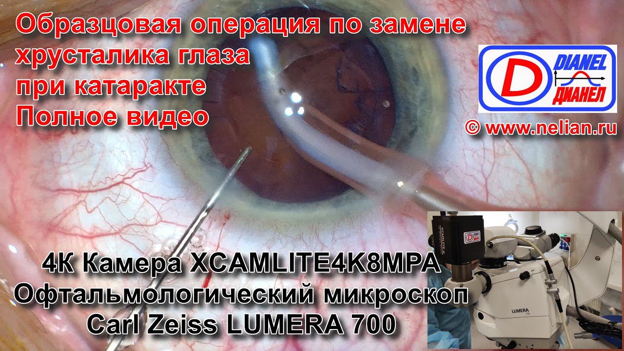 Операция по замене хрусталика глаза при катаракте полностью на камеру офтальмологического микроскопа