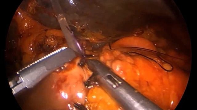 Рак поджелудочной железы