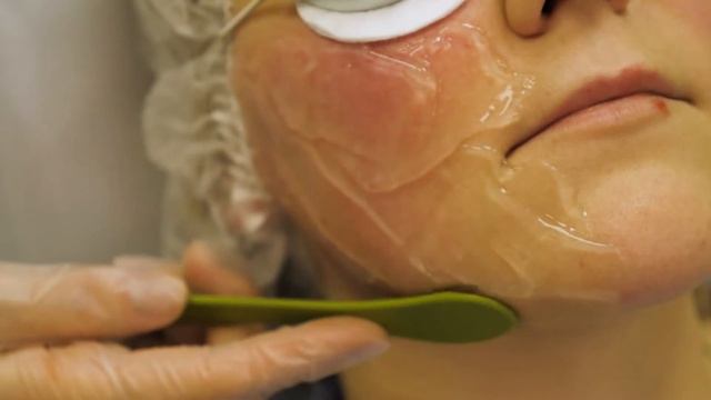 Лечение купероза аппаратом PALOMAR ICON смотреть онлайн