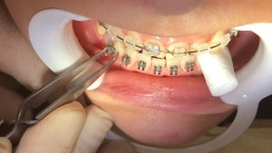 Установка комбинированных брекетов