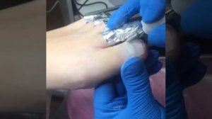 Протезирование ногтя при грибке