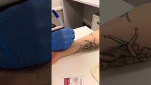 Прик-тесты или иммуноглобулин IgE — что выбрать?