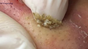 #3 Blackhead Removal Удаление черных точек