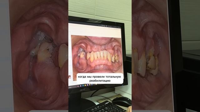 Возможно ли прийти к стоматологу и сделать «зубы за один день». смотреть онлайн