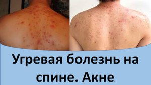 Угревая болезнь на спине