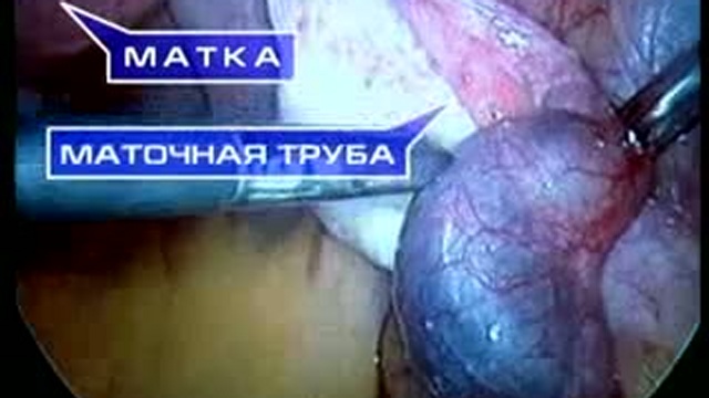 Внематочная беременность - угроза жизни
