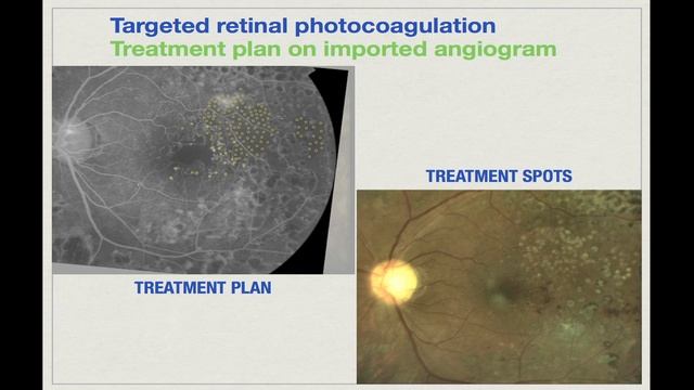 Targeted navigated retinal photocoagulation (Navilas®) with Igor Kozak, M.D., PhD. смотреть онлайн