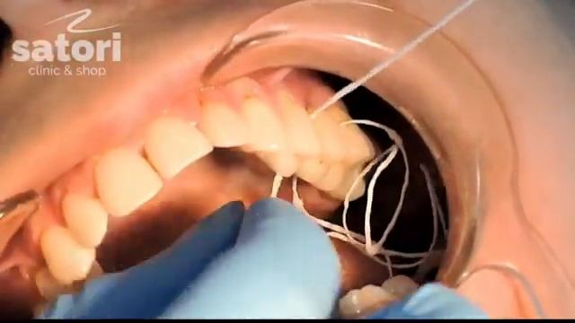 Фиксация керамического моста смотреть онлайн