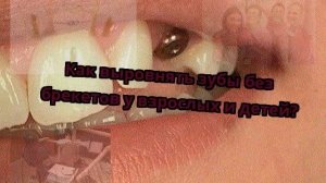 Как выровнять зубы без брекетов у взрослых и детей?