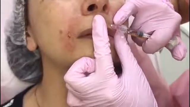 Бланширование смотреть онлайн