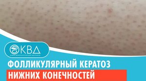 ?? Фолликулярный кератоз нижних конечностей. Клинический случай №623