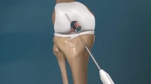 Лечение разрыва передней крестообразной связки колена. Замена ПКС на искусственное сухожилие