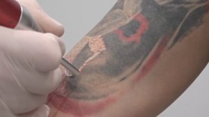 Лазерное удаление тату Picoplus