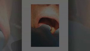 Пациент "Г". Циркониевые протезы на винтовой фиксации, на имплантатах мегаджен  4 я стоматология.